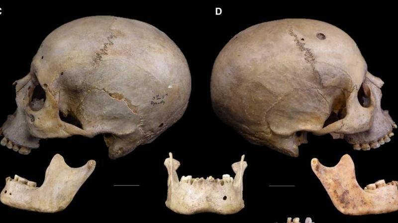 Le crâne vieux de 4 000 ans qui révèle comment les Égyptiens tentaient d&rsquo;opérer le cancer